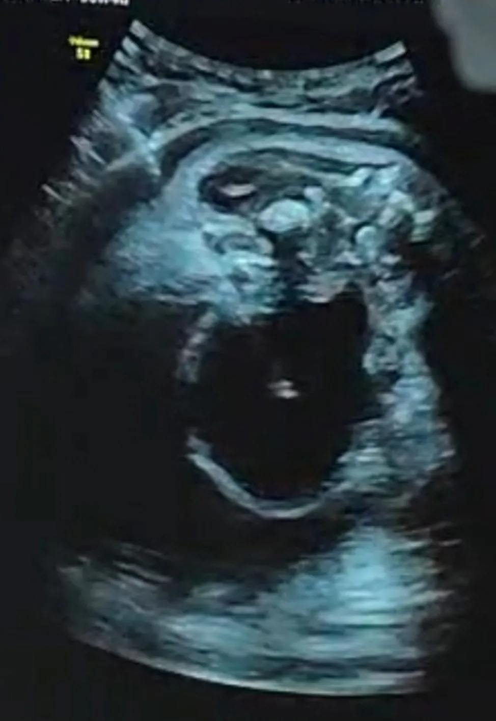 Intra-operative scan